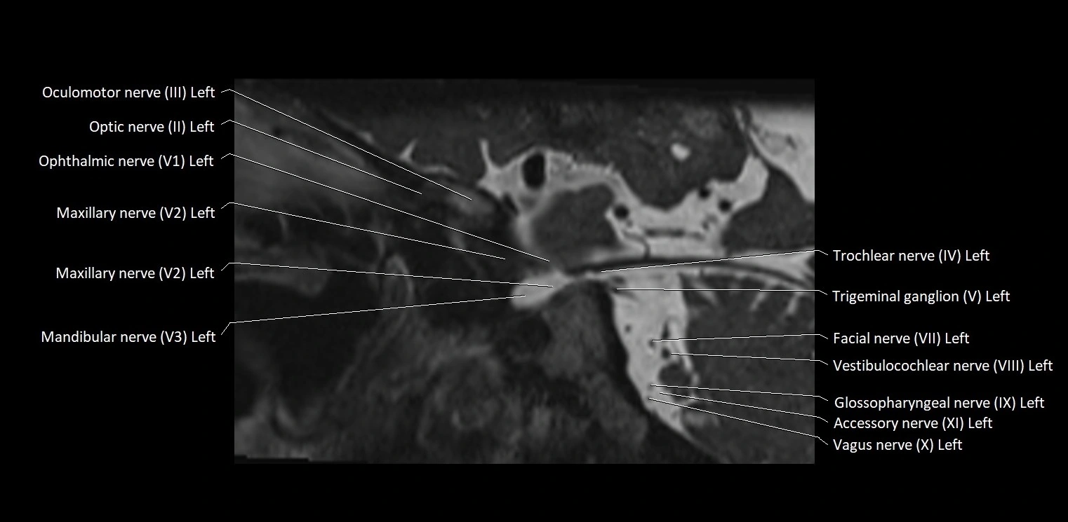 Cranial nerve sagittal anatomy MRI 3T image 20.webp